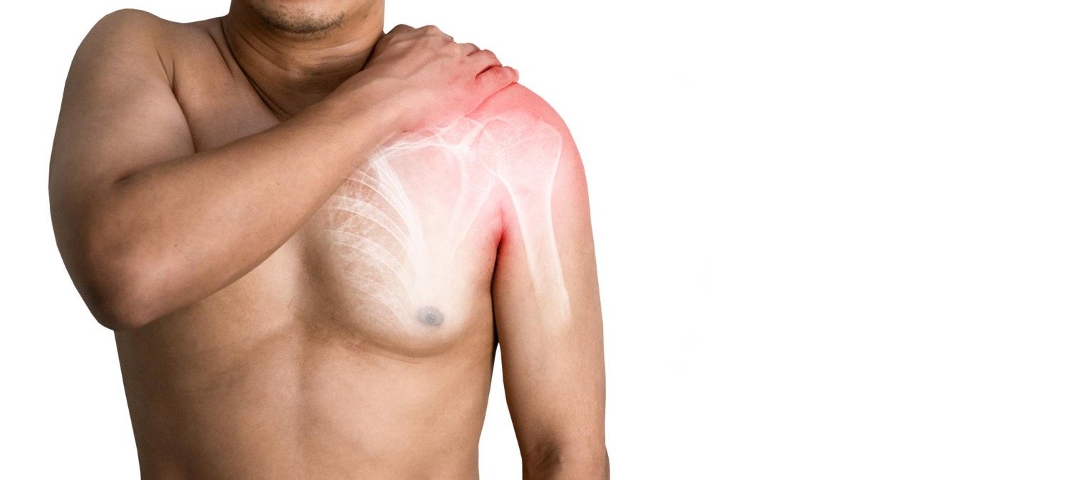 Scapula (Shoulder Blade) Fracture