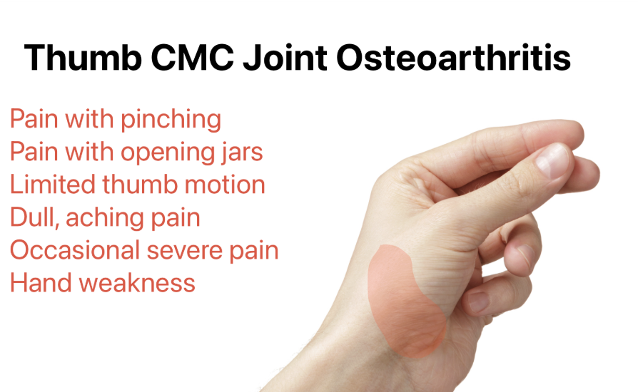 Thumb Basal Joint Arthritis (CMC Arthritis)