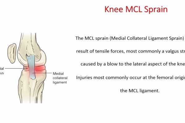 MCL Injury (Medial Collateral Ligament Sprain) - Dr Senthilvelan