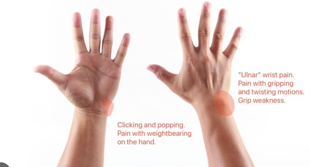 TFCC Injuries & Ulnar-Sided Wrist Pain