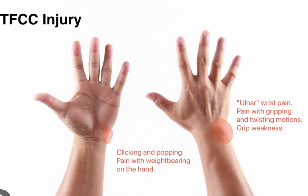 TFCC Injuries & Ulnar-Sided Wrist Pain