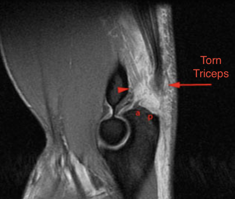 Triceps rupture MRI