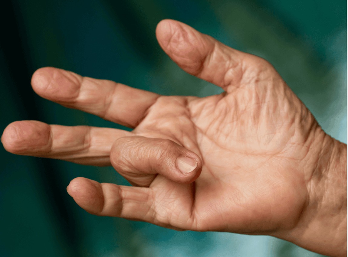 Trigger Finger (Stenosing Tenosynovitis)