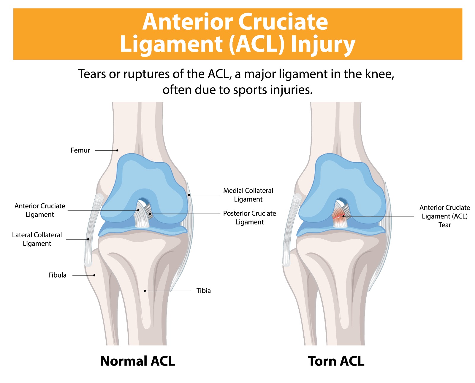 ACL Tear (Anterior Cruciate Ligament Rupture)