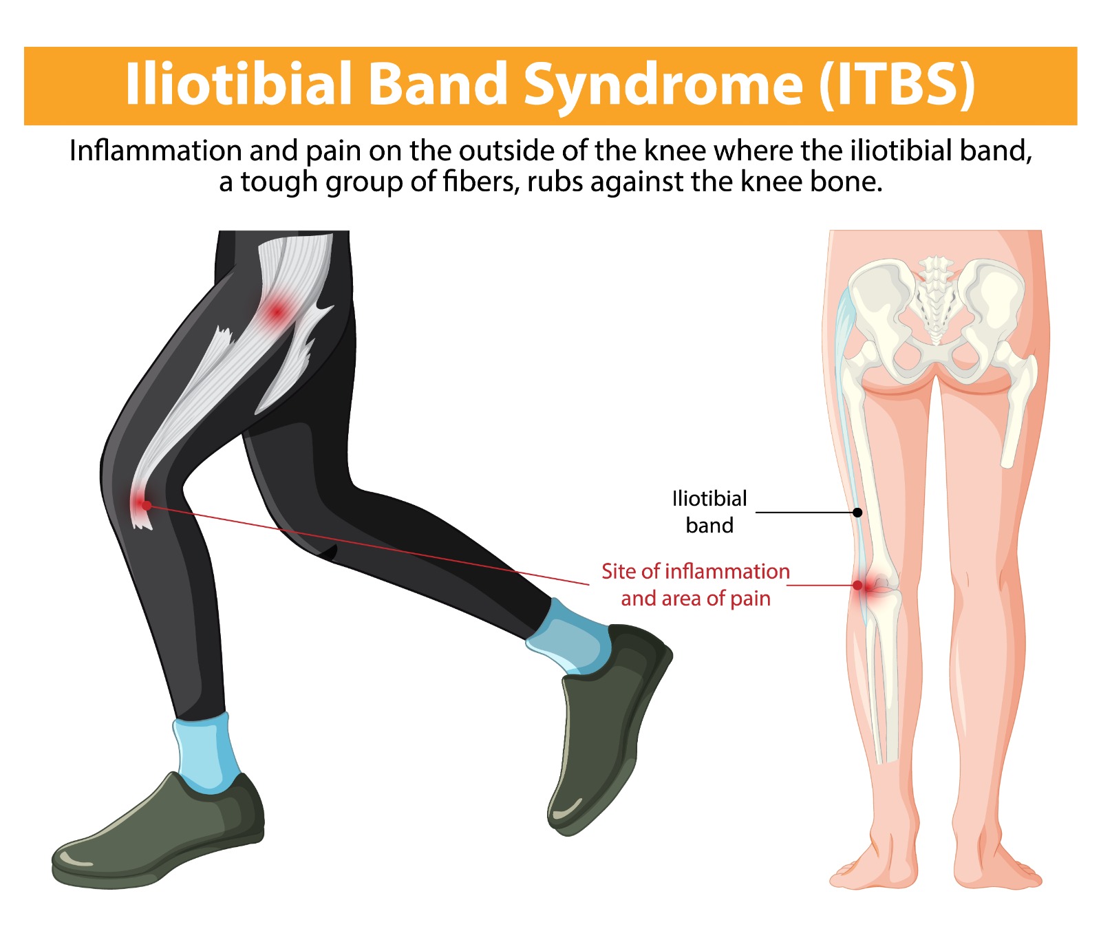 Iliotibial Band Syndrome (IT Band Syndrome)