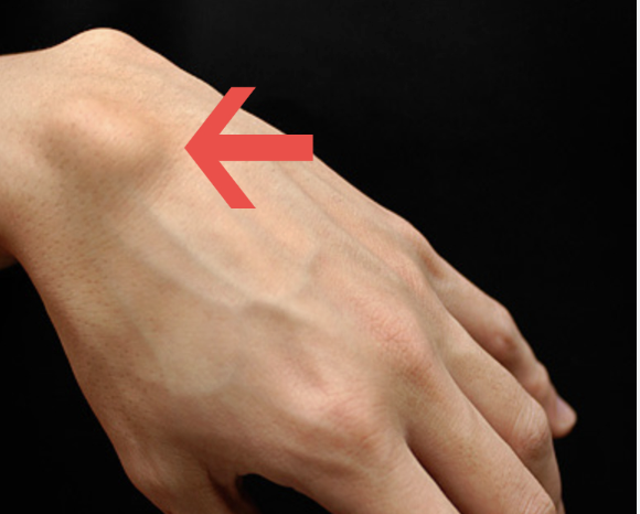 Ganglion Cysts