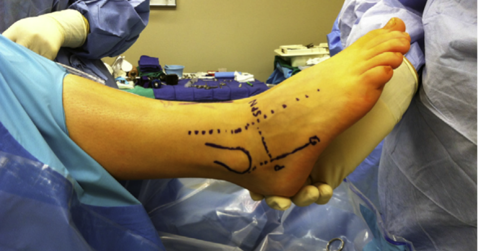Ankle-arthroscopy-1
