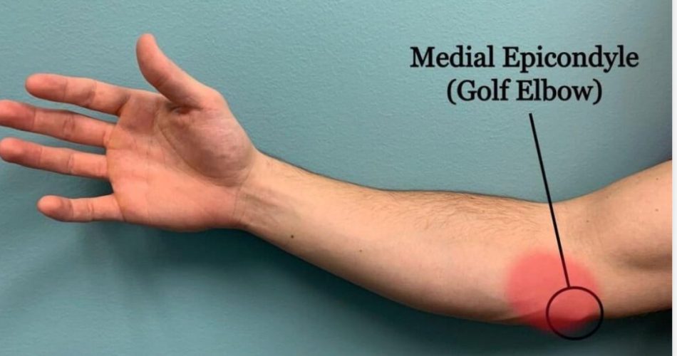 Medial Epicondyltis Image