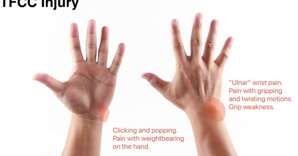 TFCC Injuries & Ulnar-Sided Wrist Pain