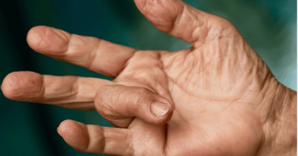 Trigger Finger (Stenosing Tenosynovitis)