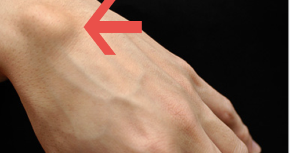 Ganglion Cysts